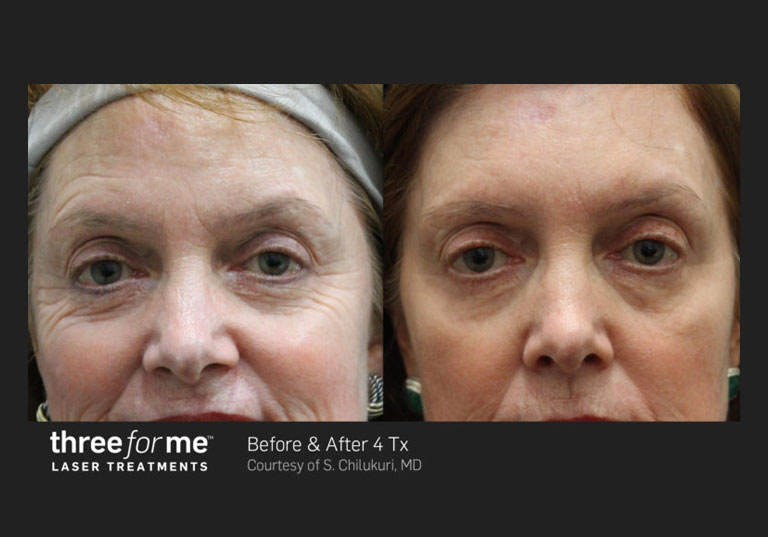 Wrinkle Treatment in Columbia SC Botox in Lexington Irmo